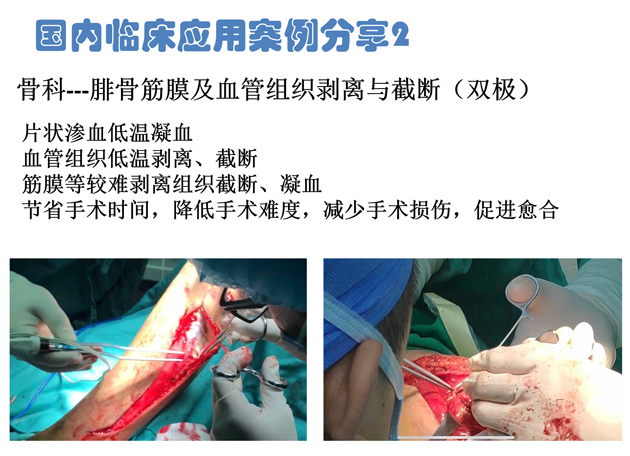 低溫射頻刀骨科雙極應用