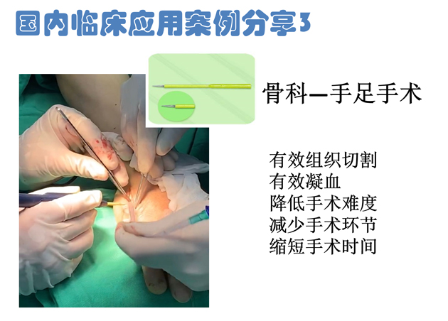 低溫射頻刀骨科手足手術應用